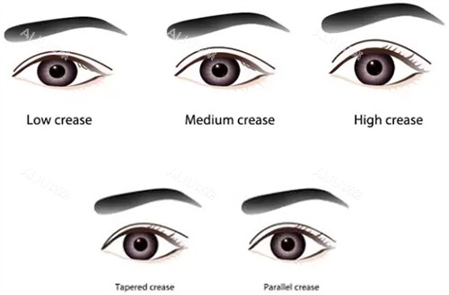 不同类型的双眼皮 不同类型的双眼皮