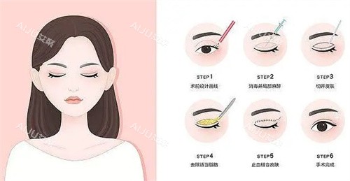 全切双眼皮过程卡通图 全切双眼皮过程卡通图