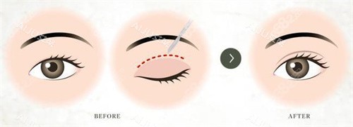 双眼皮术对比宣传图 双眼皮术对比宣传图