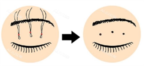 皮下速接双眼皮操作过程图解 皮下速接双眼皮操作过程图解
