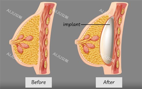假体隆胸植入的层次 假体隆胸植入的层次