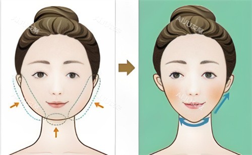 面部吸脂对比卡通 面部吸脂对比卡通