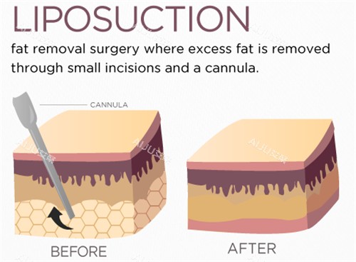 吸脂手术前后动画对比 吸脂手术前后动画对比