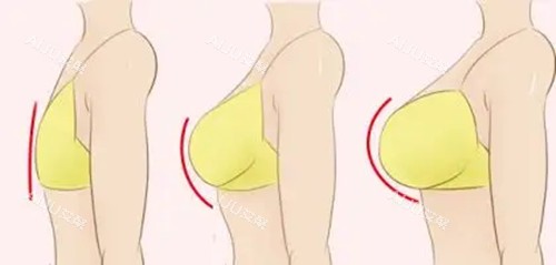 胸部整形卡通示意图 胸部整形卡通示意图