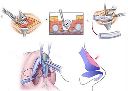 肋软骨隆鼻改善过程图 肋软骨隆鼻改善过程图