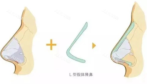 L型假体隆鼻步骤示意图 L型假体隆鼻步骤示意图