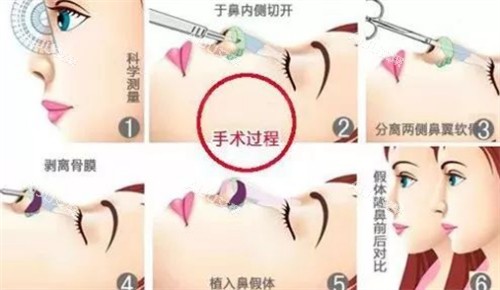 隆鼻过程图解 隆鼻过程图解