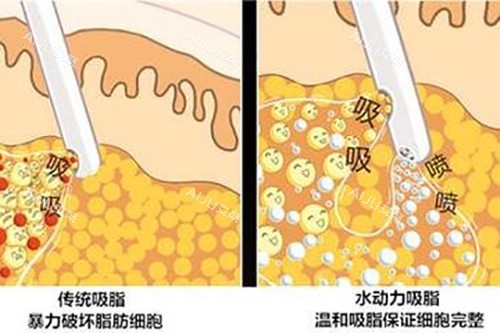 吸脂示意图