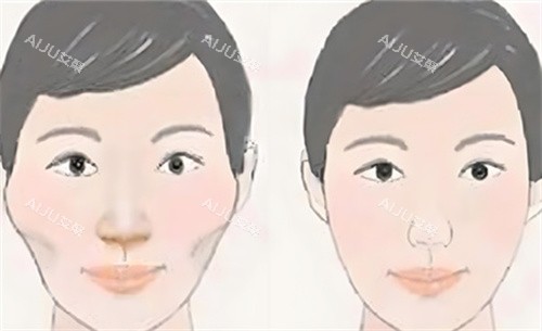 颧骨内推术前后对比动画图 颧骨内推术前后对比动画图