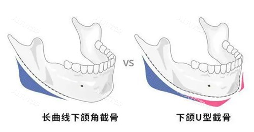 下颌角截骨位置示意图 下颌角截骨位置示意图