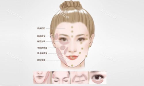 填充部位示意图 填充部位示意图