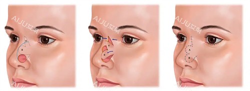 鼻缺失修复一览