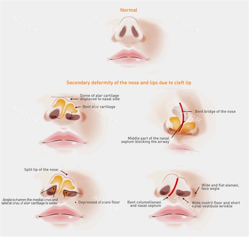 不同情况的鼻孔
