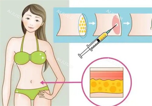 吸脂手术腰部 吸脂手术腰部