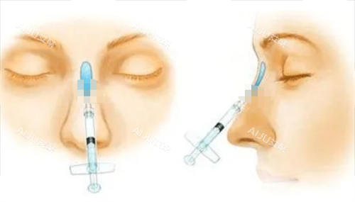 玻尿酸注射隆鼻动画展示图 玻尿酸注射隆鼻动画展示图