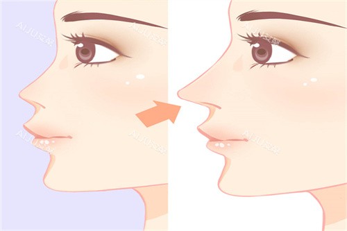 隆鼻手术前后展示图 隆鼻手术前后展示图