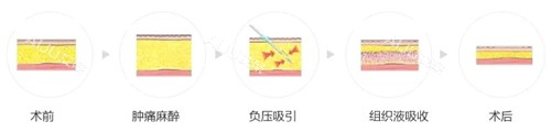 吸脂过程图解 吸脂过程图解