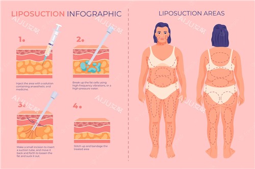 吸脂前后对比照 吸脂前后对比照