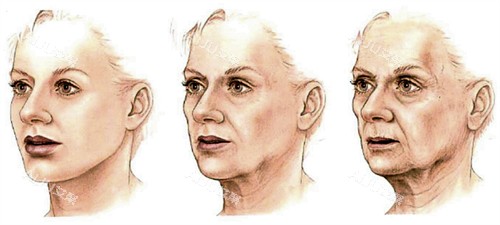 面部提升的皮肤前后对比 面部提升的皮肤前后对比