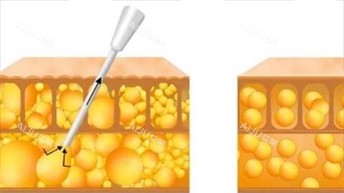 吸脂过程动画脂肪前后变化 吸脂过程动画脂肪前后变化