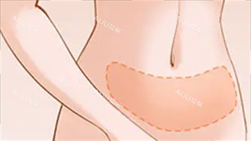 腹部吸脂成效展示图 腹部吸脂成效展示图