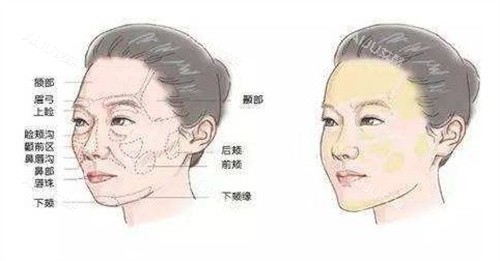 胶原蛋白面部填充前后 胶原蛋白面部填充前后