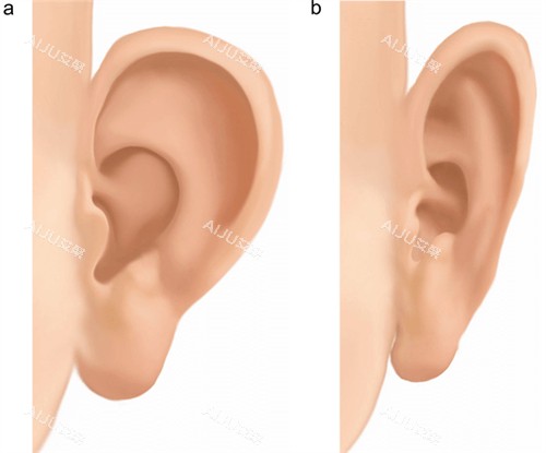 改善耳朵形状 改善耳朵形状