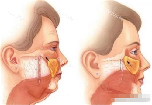 拉皮前后皮肤内部以及表面变化图 拉皮前后皮肤内部以及表面变化图