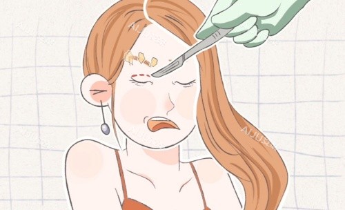 拉双眼皮示意图 拉双眼皮示意图