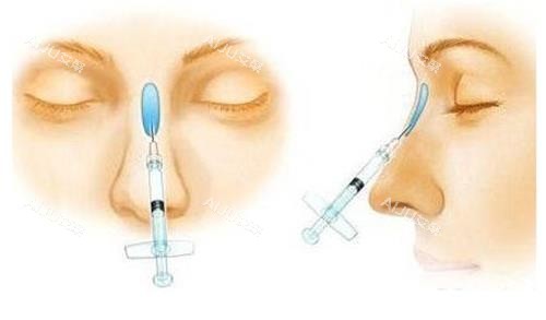 液态隆鼻示意图 液态隆鼻示意图