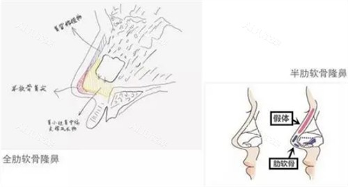 全肋和半肋隆鼻的区别图解 全肋和半肋隆鼻的区别图解