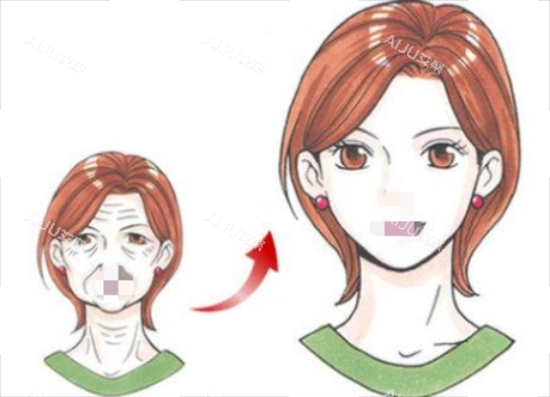 拉皮手术前后对比图 拉皮手术前后对比图