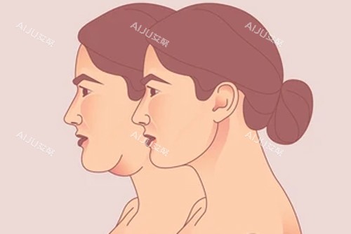 颈部拉皮变成天鹅颈 颈部拉皮变成天鹅颈