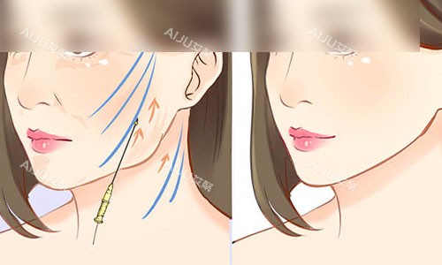 拉皮手术成效示意图 拉皮手术成效示意图