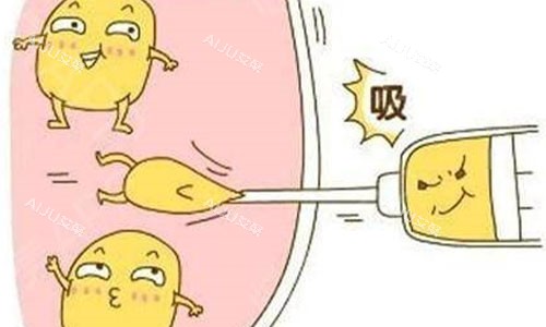 吸脂手术示意图 吸脂手术示意图