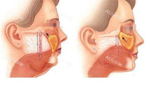 拉皮手术皮下组织切面对比展示图 拉皮手术皮下组织切面对比展示图