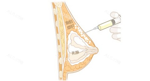 自体脂肪隆胸通图 自体脂肪隆胸通图