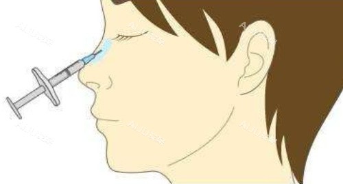 注射隆鼻侧面 注射隆鼻侧面