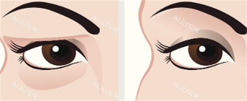 祛眼袋前后对比2 祛眼袋前后对比2