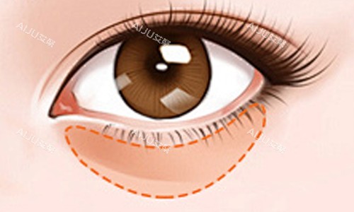 眼袋位置及颜色展示 眼袋位置及颜色展示