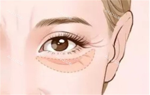 眼袋形成的衰老 眼袋形成的衰老