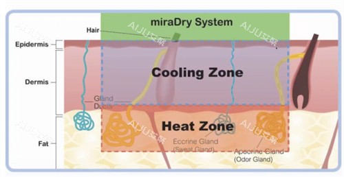 miraDry清新微波正规吗