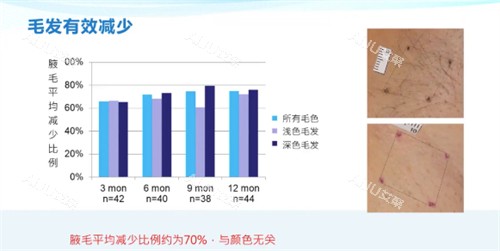 miraDry清新微波结果
