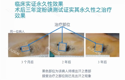 miraDry清新微波实例