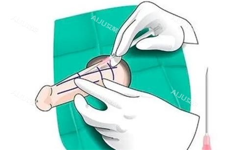 海绵体注射动画演示图