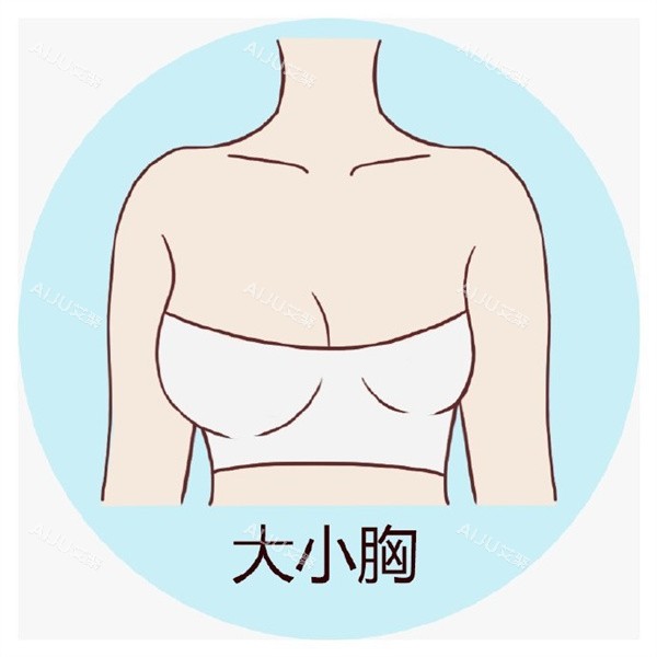 乳房不对称 乳房不对称