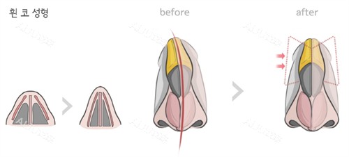 鼻整形前后对比图一览 鼻整形前后对比图一览