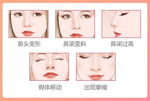 鼻整形图示 鼻整形图示
