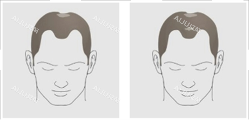 发际线及头顶头发脱落素材 发际线及头顶头发脱落素材