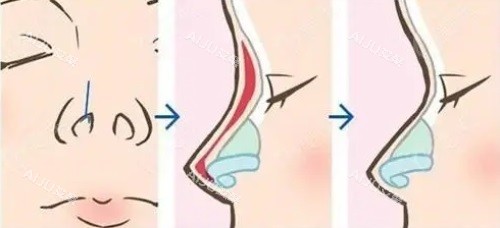 鼻整形图片 鼻整形图片